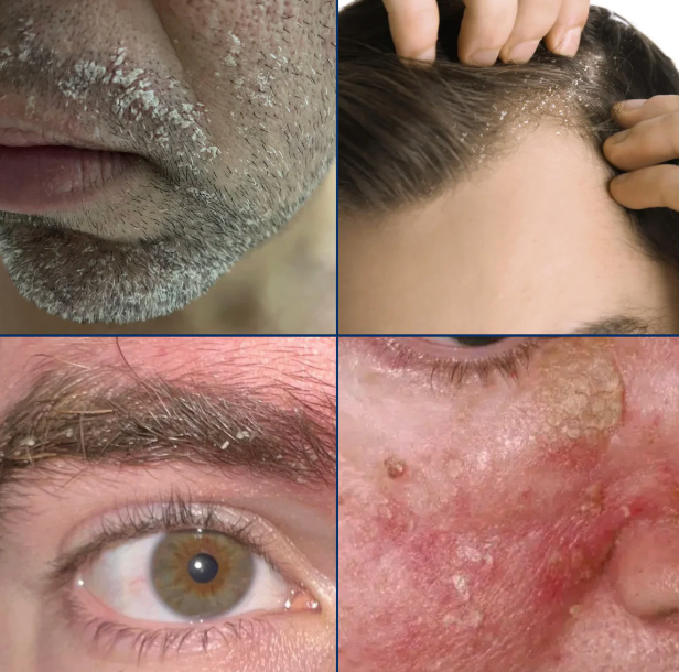 Men's Seb Derm Treatment