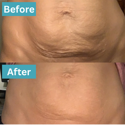 Anti Cellulite Massage Oil™